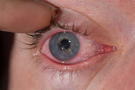 wrinkled cornea